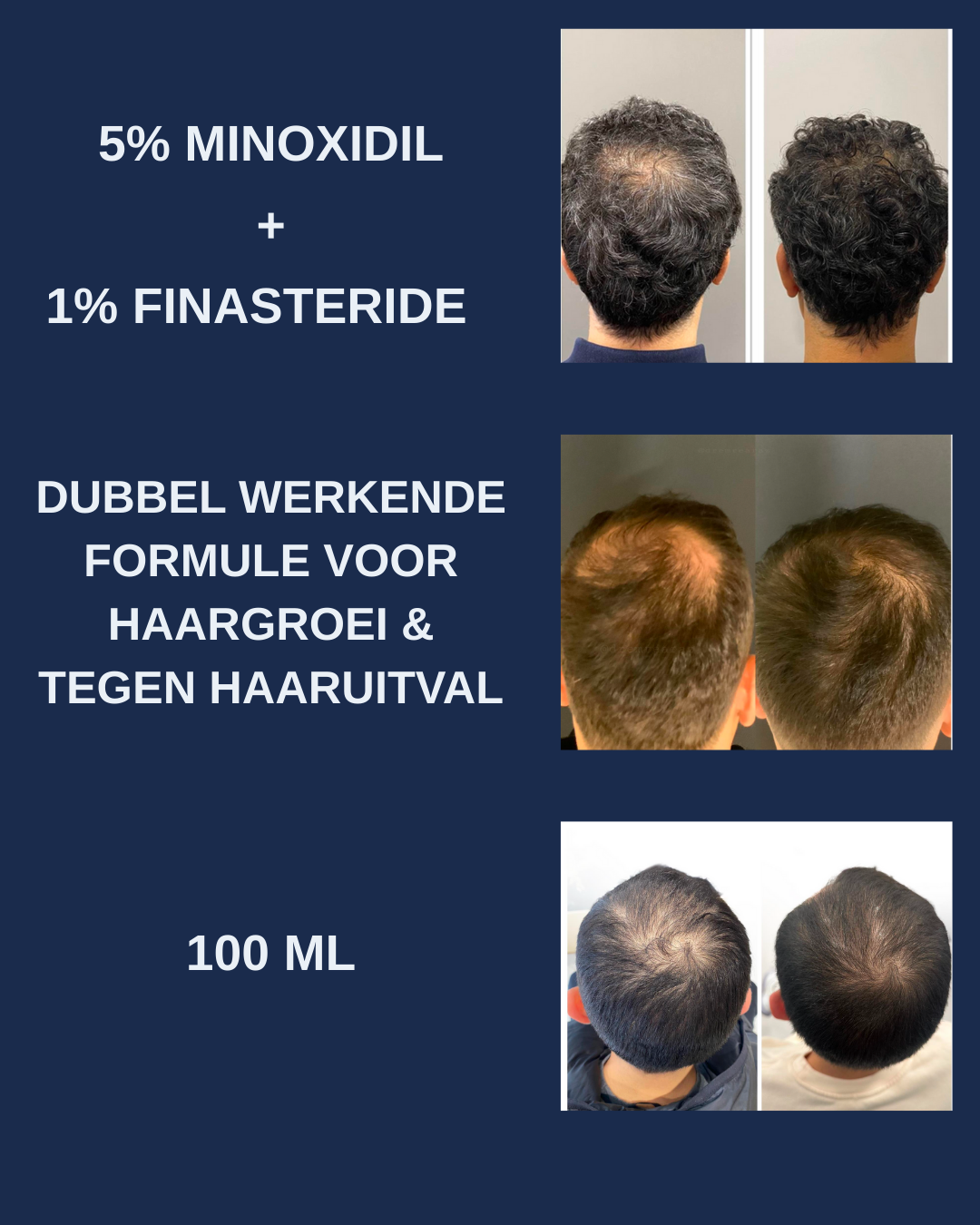 Minoxidil 5% Spray – Dubbel Werkende Formule voor Haargroei & Tegen Haaruitval